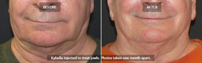 kybella injections double chin