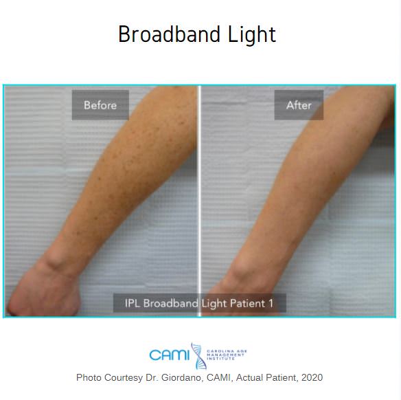 remove dark spots with BBL light therapy