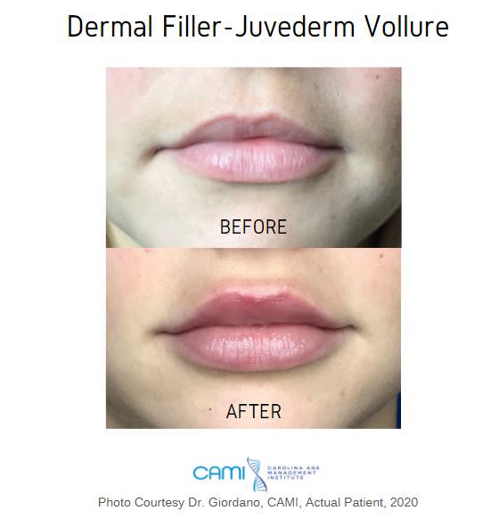dermal filler juvederm before and after
