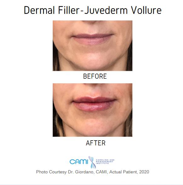 dermal filler juvederm before and after