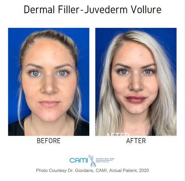 dermal fillers before and after pictures