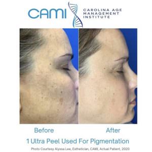 chemical peel cost treatment at cami charlotte nc