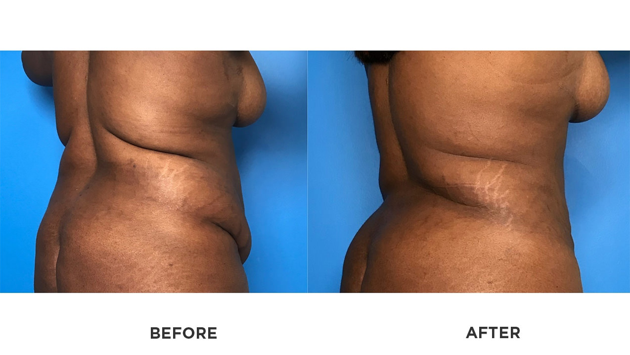 smartlipo laser lipo before and after pictures