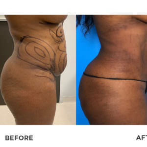 smartlipo before and after pictures