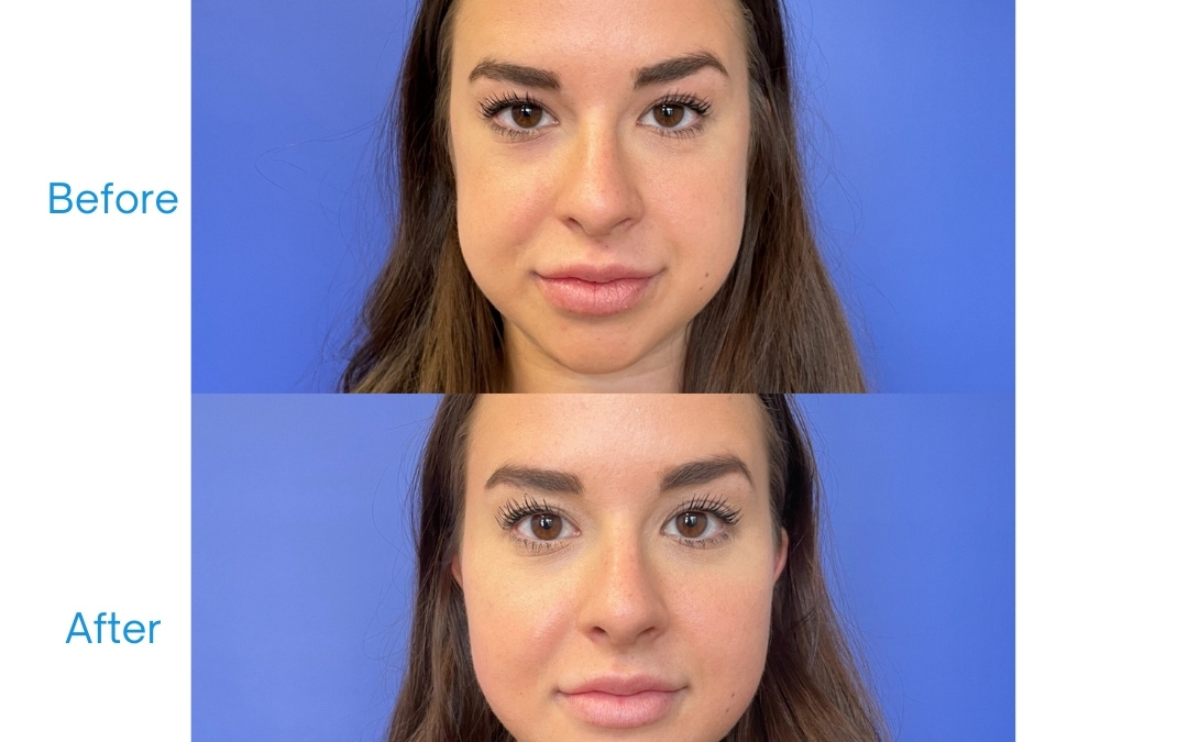 Everything You Need to Know About Facial Balancing with Fillers