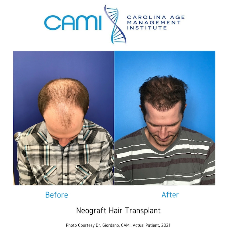 hair transplantation clinic