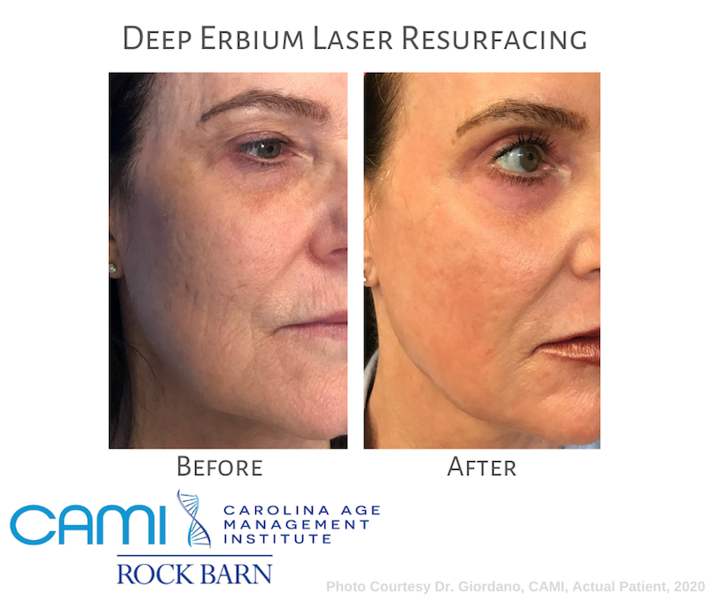 laser skin resurfacing treatment