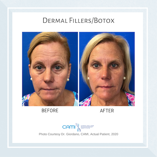 BOTOX® vs. Dermal Fillers: Which One Should You Get?
