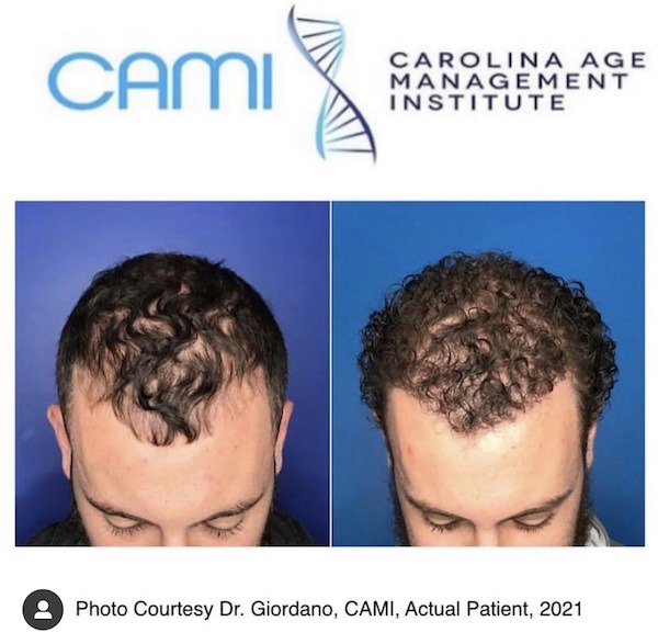 hair loss specialist in charlotte nc