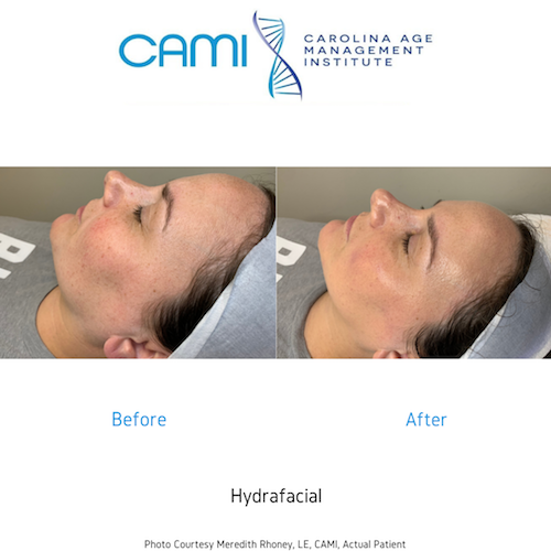 hydra-facial-spas-in-charlotte