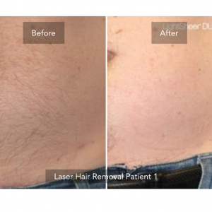 laser hair removal packages deals