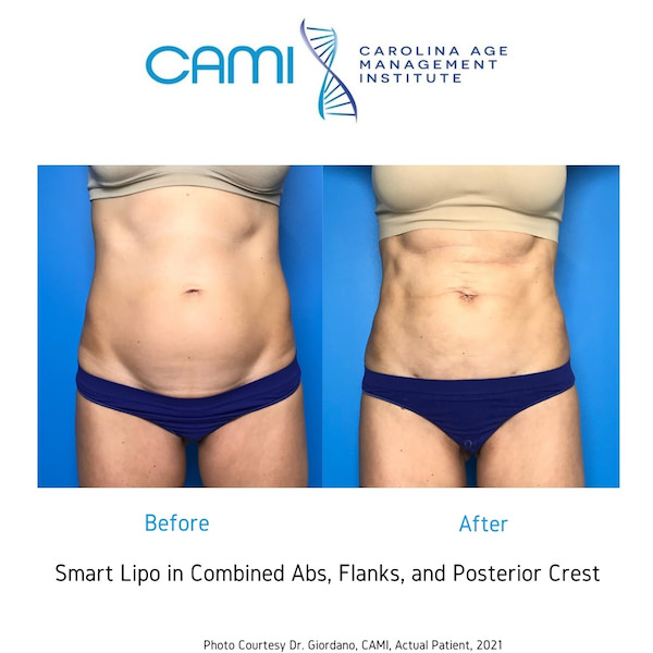 laser lipo before and after photos