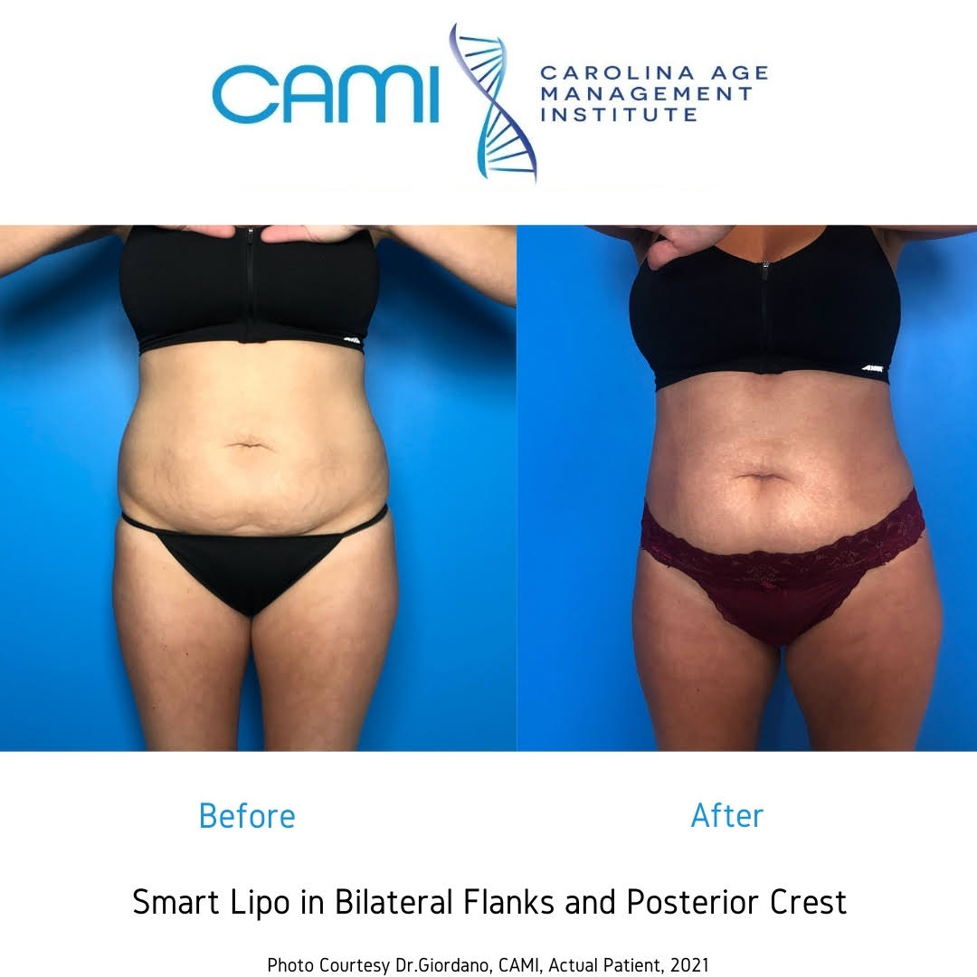 laser lipo before and after photos stomach