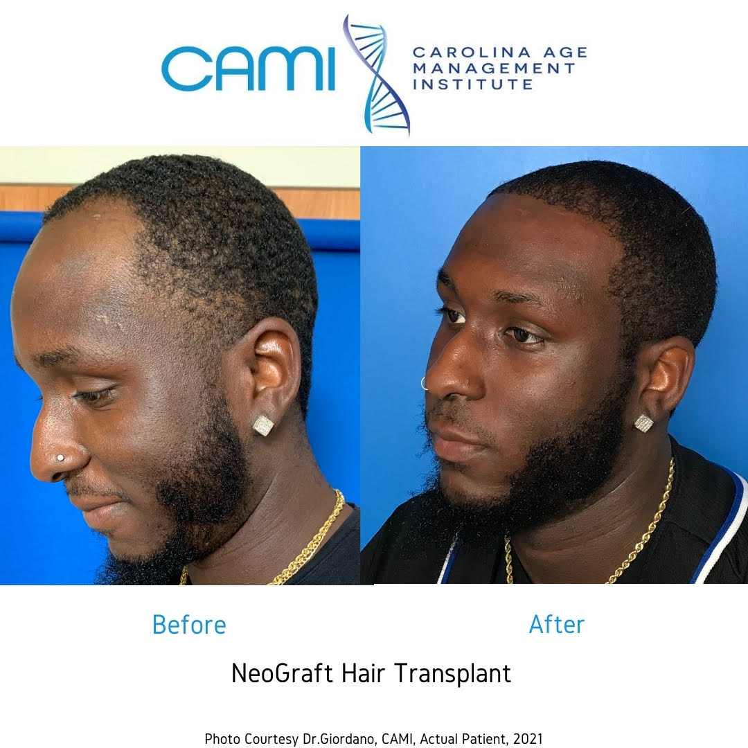 neograft before and after photos