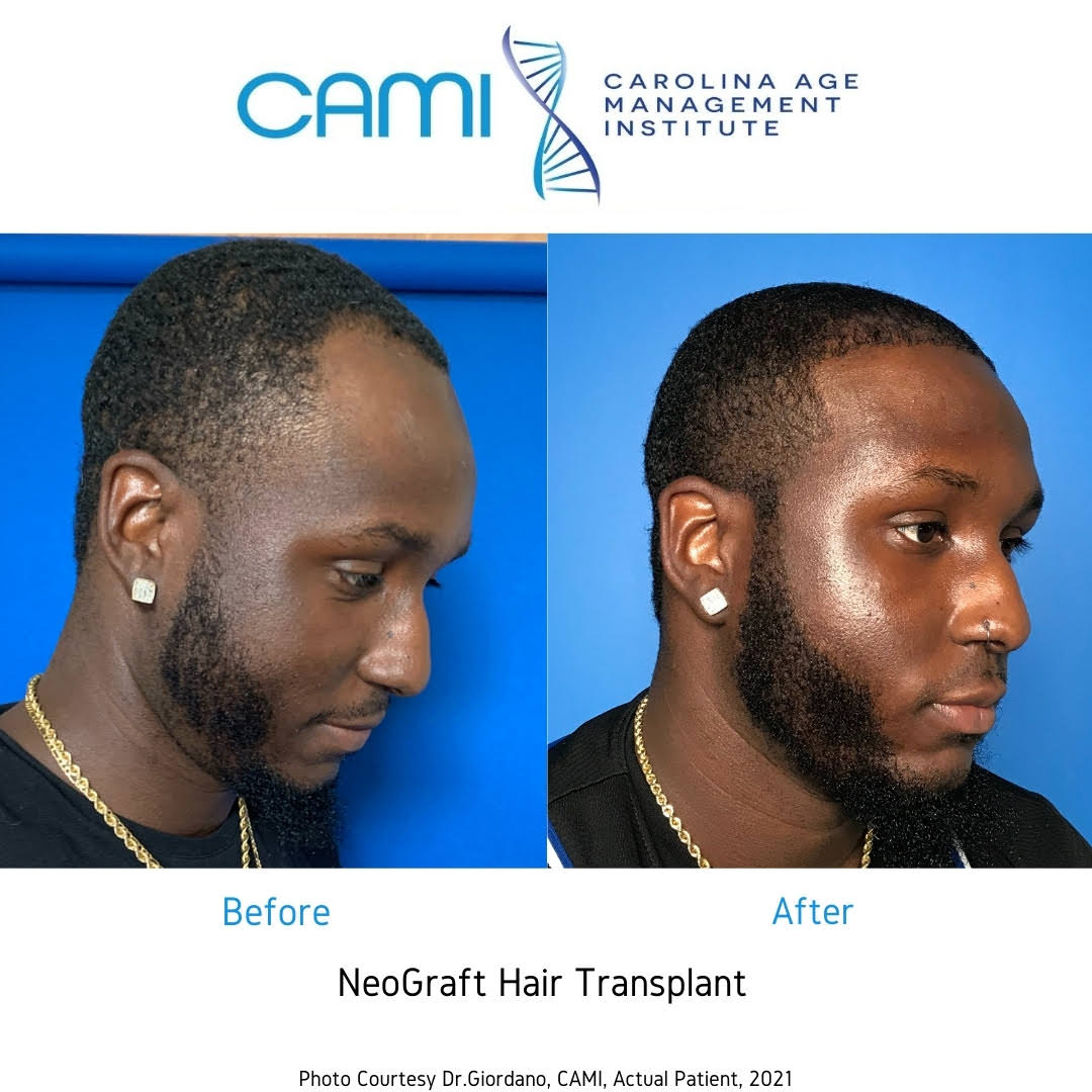 neograft before and after photos