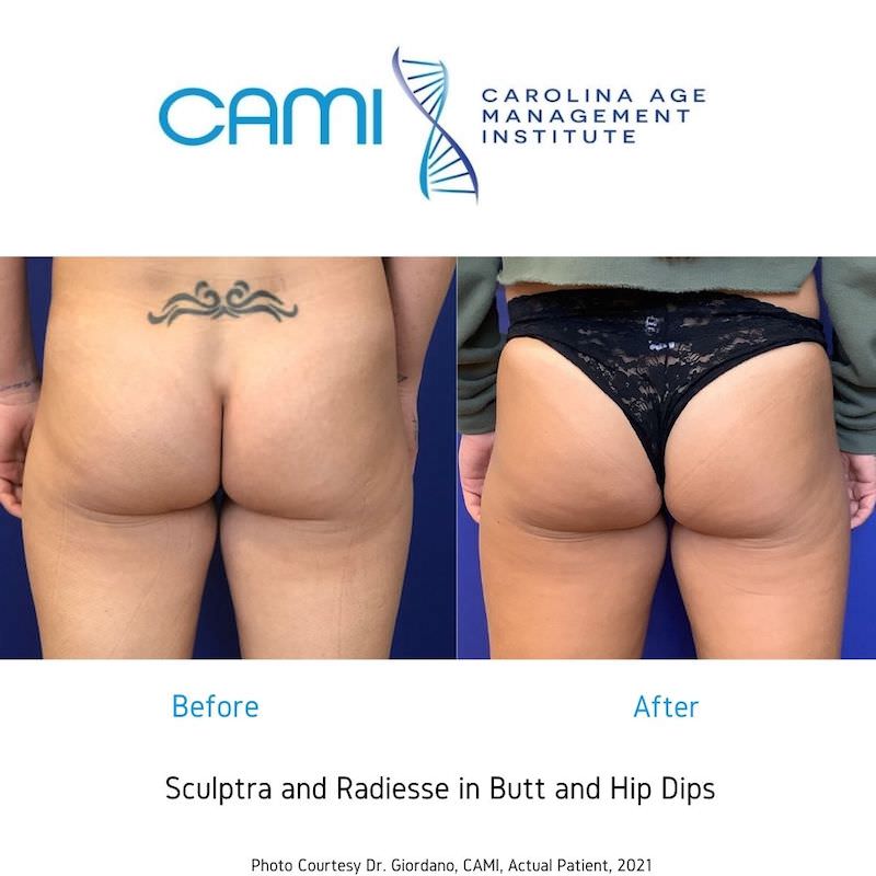 sculptra bbl before and after photos