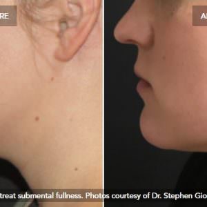 chin fat removal cost
