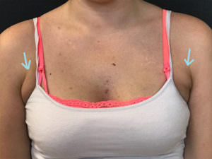 bra fat removal