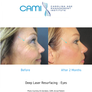 non surgical facelift using laser technology