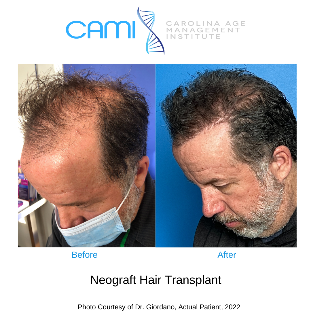 neograft fue hair transplant