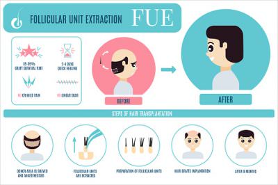 how does a hair transplant work