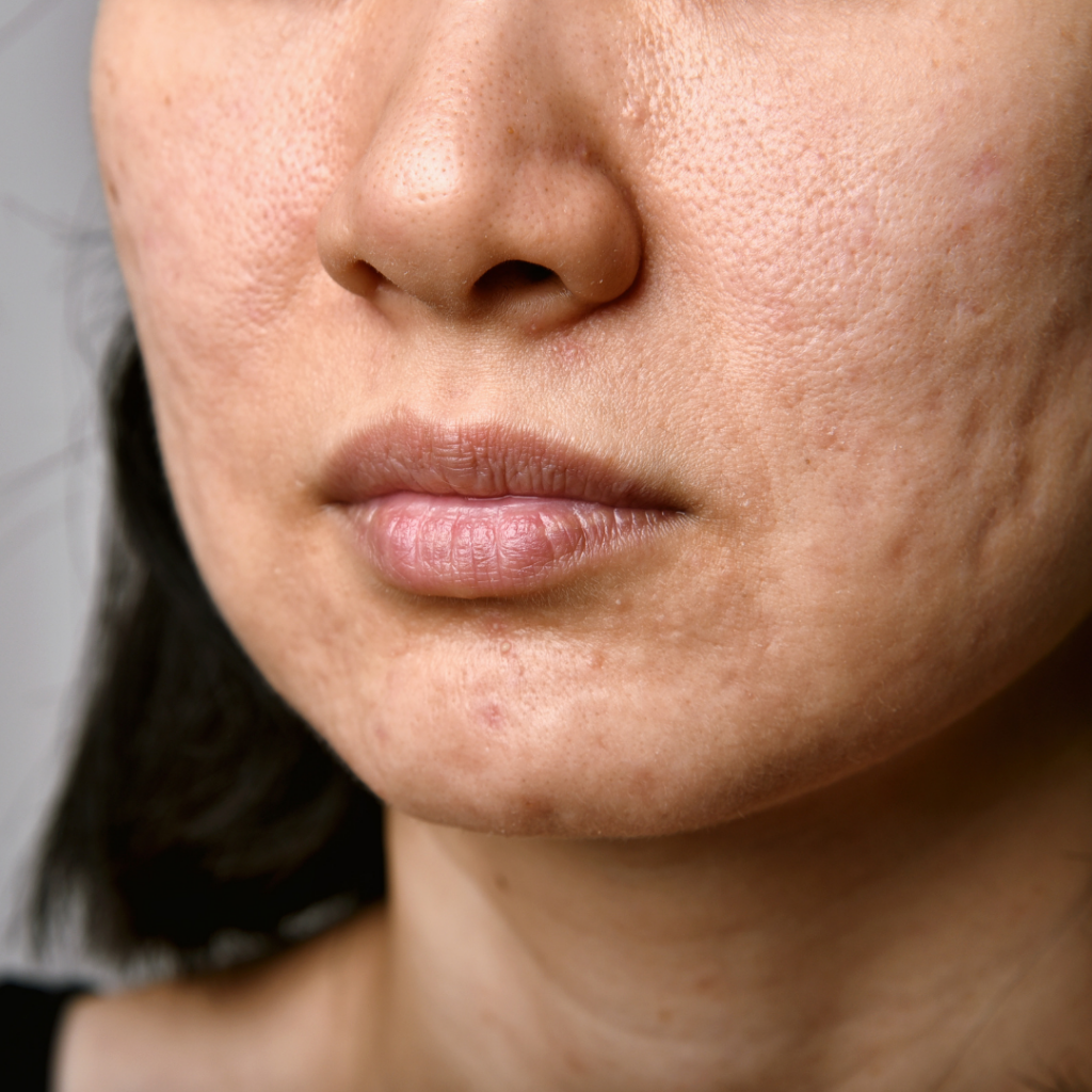 do chemical peels help acne scars