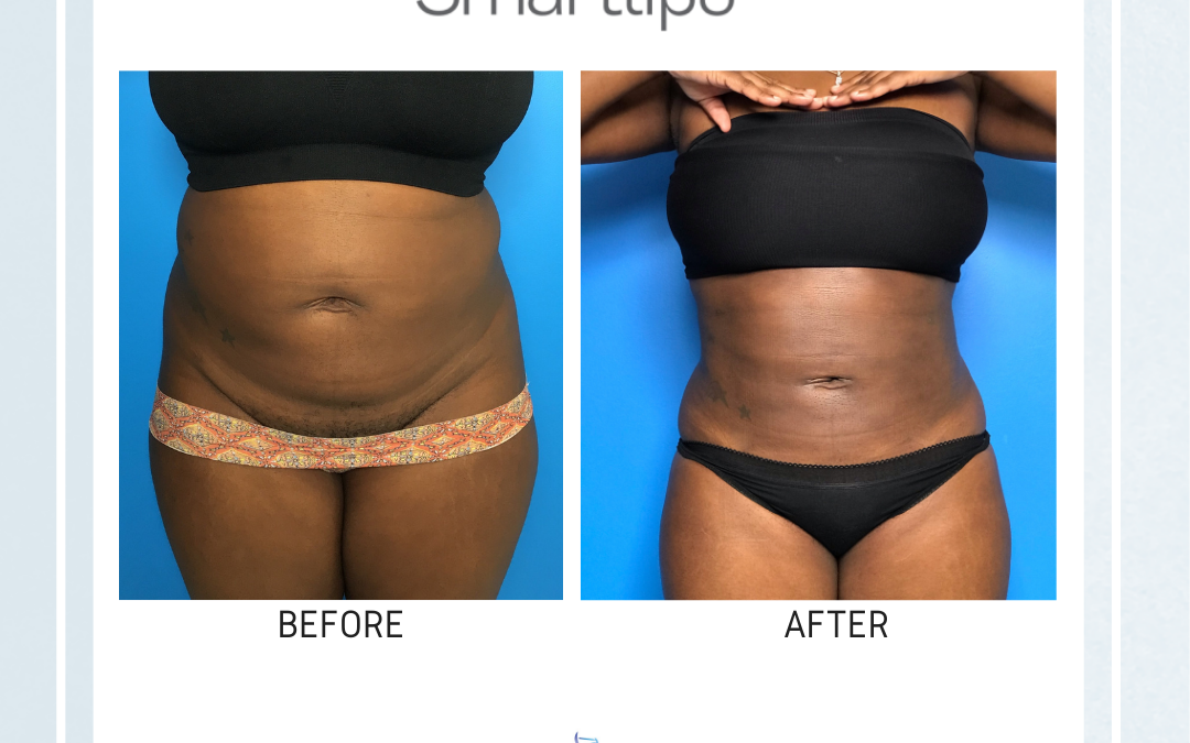 best body contouring treatment