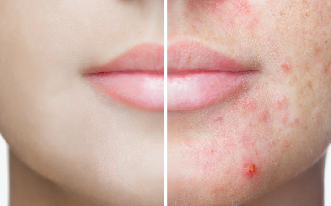What Type of Facial is Best for Acne and Acne Scars?
