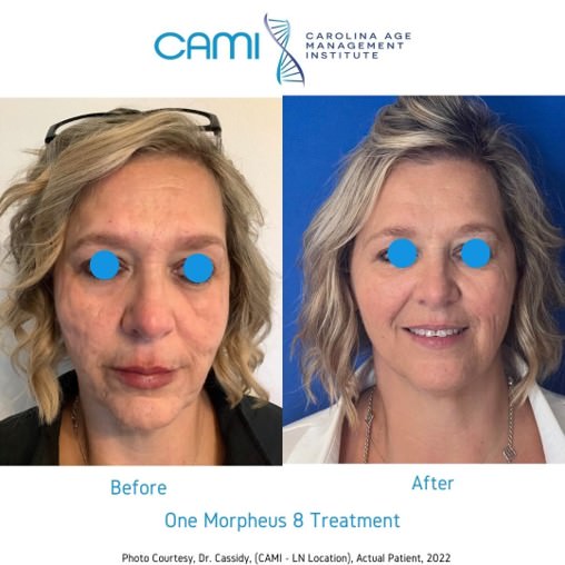 morpheus8 scar treatment before and after