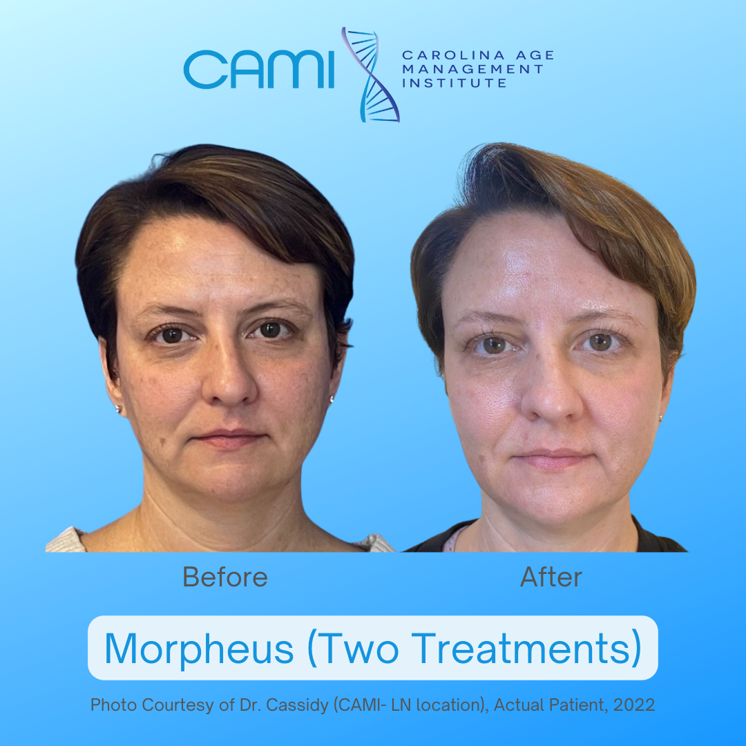 morpheus8 skin tightening before and after